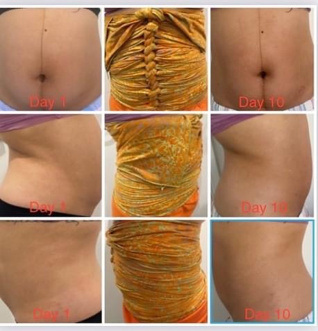 before-after-belly-binding-results-balwyn