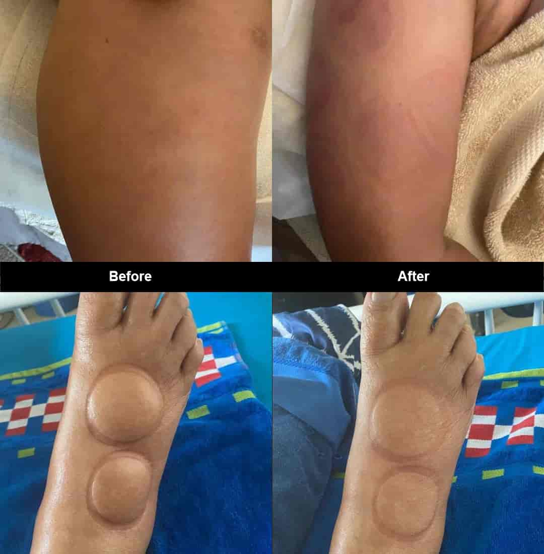 lymphatic-drainage-before-after4